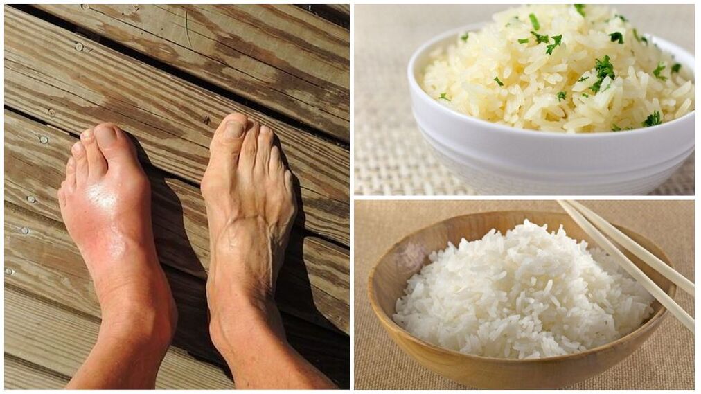Köszvényes betegeknek rizs alapú étrend javasolt. 